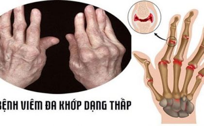 Viêm đa khớp dạng thấp là gì và những thông tin liên quan đến bệnh