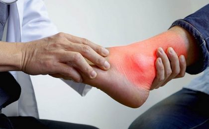 Những bài tập tốt cho người bị bệnh gout để hỗ trợ điều trị bệnh