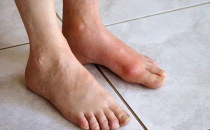 Dấu hiệu bệnh gout ở chân và phương pháp tầm soát bệnh hiệu quả