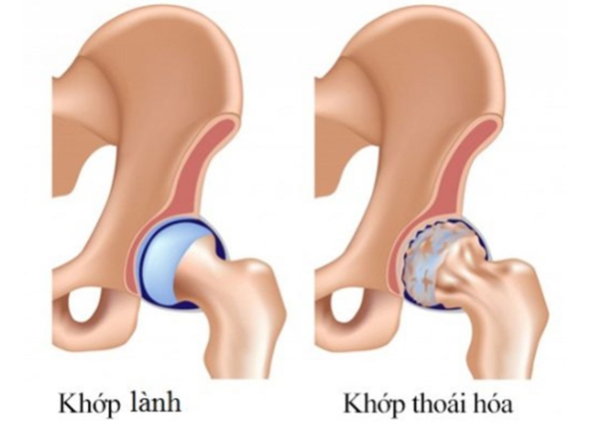 thoai-hoa-xuong2 - Copy