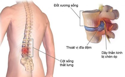 Thoát vị đĩa đệm chèn dây thần kinh nguy hiểm như thế nào?